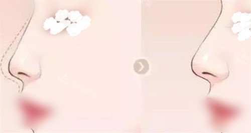 隆鼻鼻部鼻梁术前术后展示图