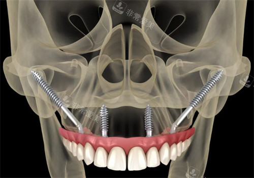 穿颧穿翼技术动画示意图