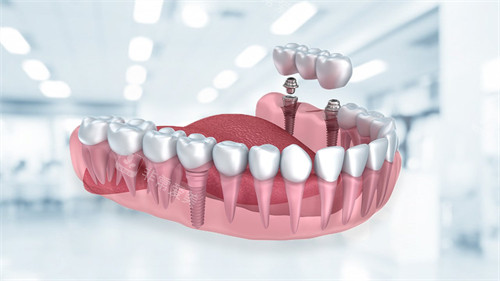 种植牙动画展示图