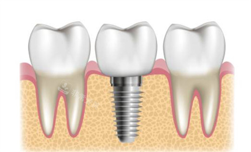 种植牙周围健康牙