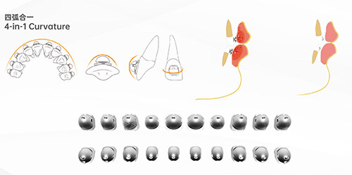牙齿矫正OBrace球面全部托槽