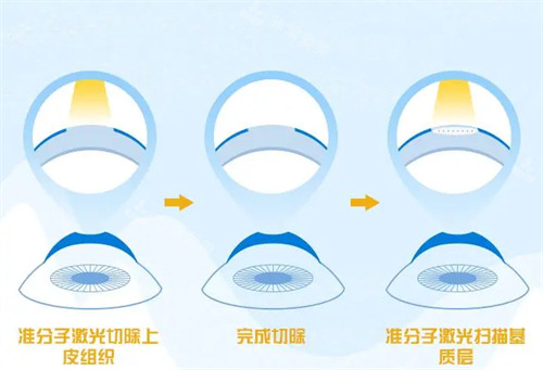 不同的近视手术