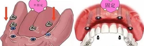 半口半固定种植牙