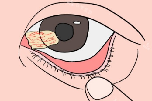 韩国整形医院做包眼角手术哪家好？这几家的细节处理真的绝了！（gio整形、eve整形、世美整形）