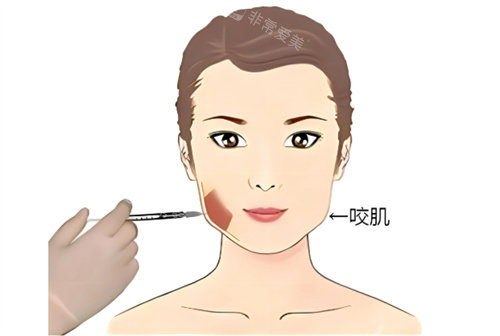 韩国改脸型实测！下颌线注射让面部线条更流畅，终于拥有理想小V脸