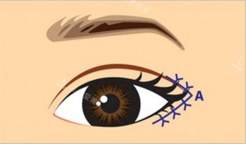 割眼角后示意图