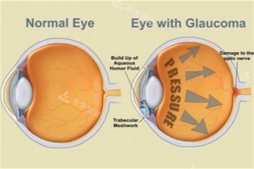 青光眼示意图