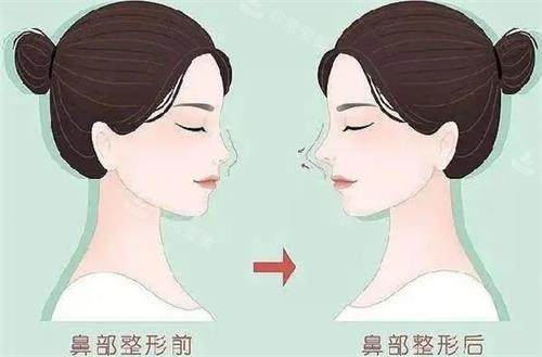 液态隆鼻前后的区别