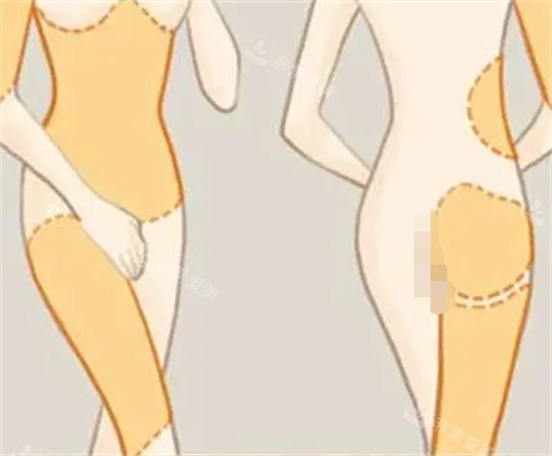 吸脂手术可以手术的部位动画展示图