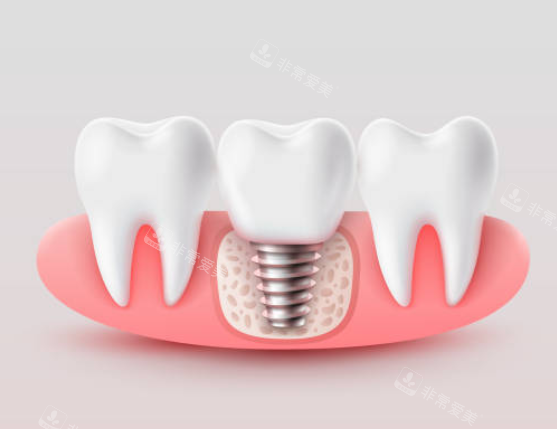 种植牙模型图示意图