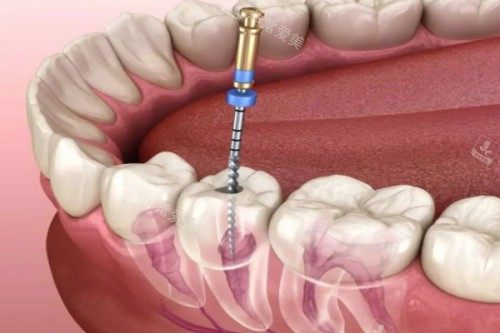 根管治疗卡通图片展示