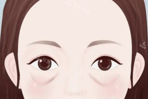 眼袋卡通展示图
