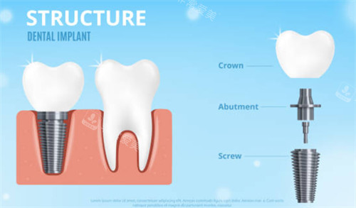 种植牙拆解示意图