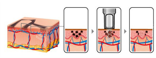 激光祛斑作用原理