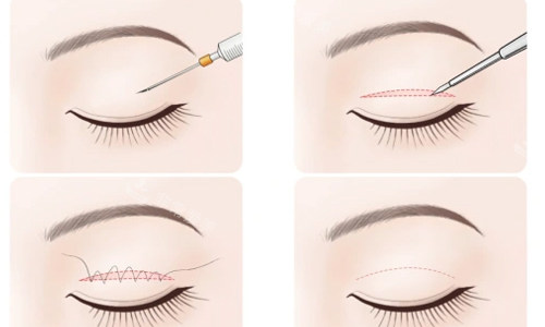 全切双眼皮简易术后流程 全切双眼皮简易术后流程