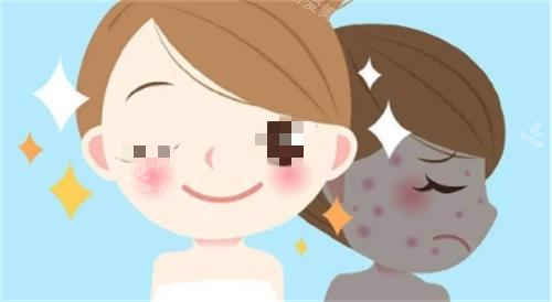 光子嫩肤成效图