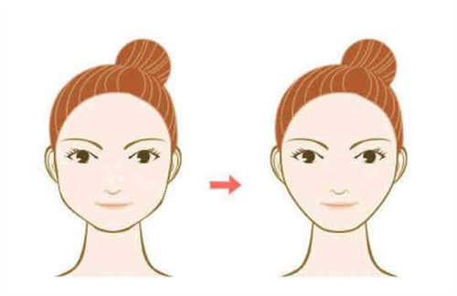 面部轮廓整形卡通图