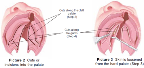 唇裂修复图片一览 唇裂修复图片一览