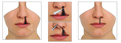 唇裂修复 唇裂修复