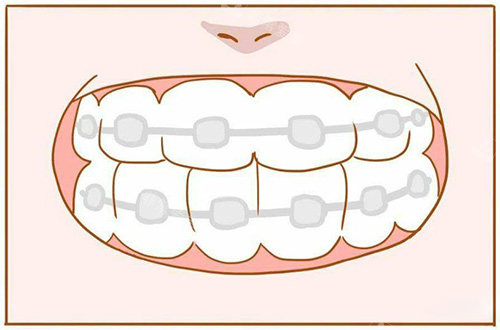 牙齿矫正漫画展示图