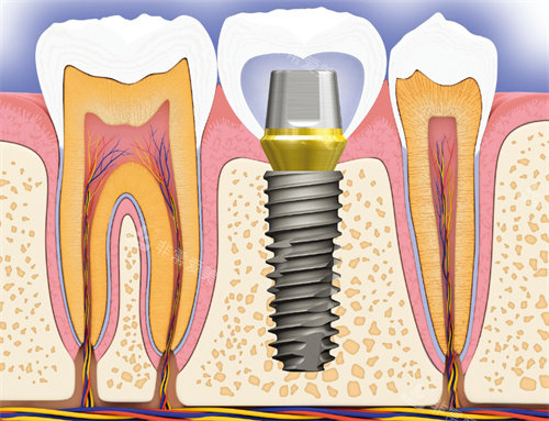 种植牙卡通图片展示
