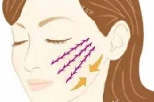 面部埋线提升卡通图