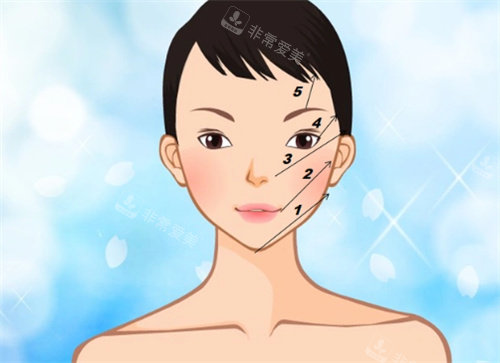 体验分享版：终于赴韩做了脸部小线雕蛋白线！术后1个月，皮肤紧致上扬超惊喜