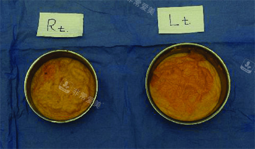 不明注射物取出来的样子