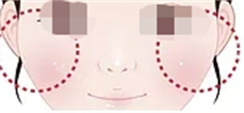 玻尿酸填充眼下填充