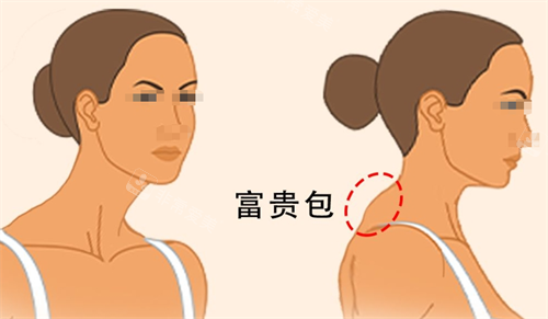 富贵包侧面展示图