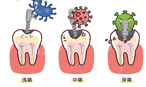 牙齿不同程度龋坏展示
