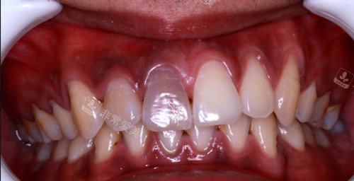 牙齿龋坏表现图