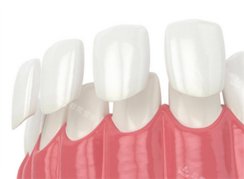 牙齿贴面动画展示图