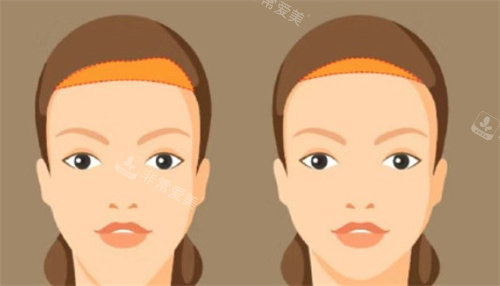额头缩小手术对比 额头缩小手术对比
