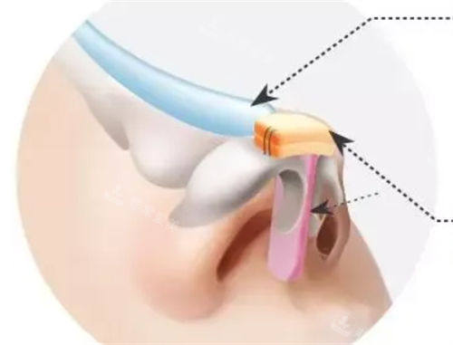 韩国美迪菲硅胶隆鼻好...