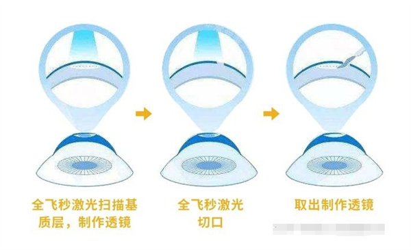 全飞秒激光治眼睛切口