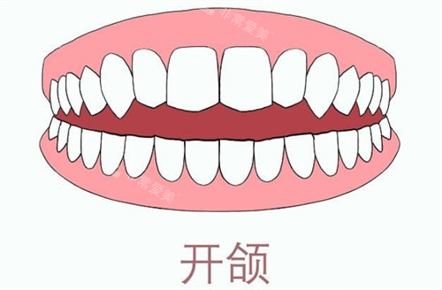 牙齿开颌