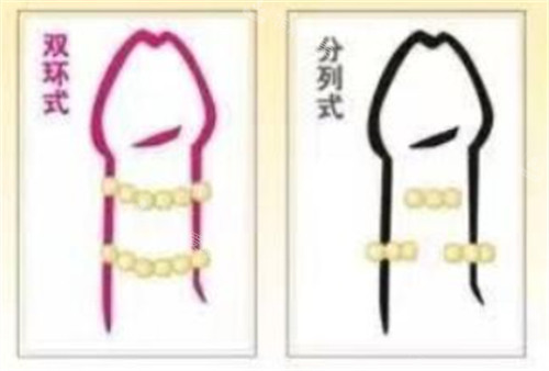 阴茎入珠术款式有哪些 阴茎入珠术款式有哪些