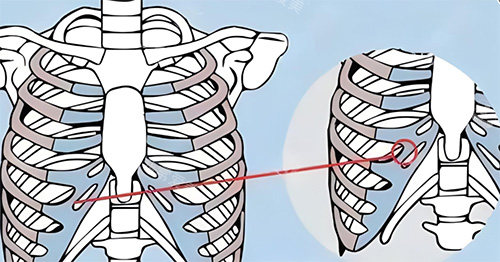 隆鼻肋骨鼻所用肋骨图
