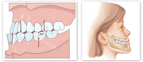 下巴内缩内部展示动画图
