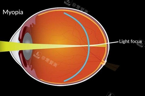 近视成像落在视网膜前
