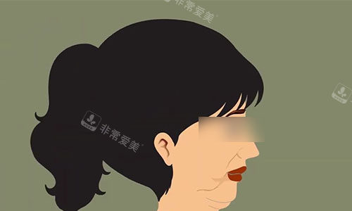 拉皮手术前的动画示意图