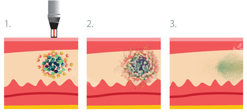 蜂巢皮秒祛斑 蜂巢皮秒祛斑