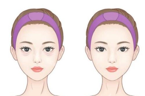 割眼袋前后对比图 割眼袋前后对比图