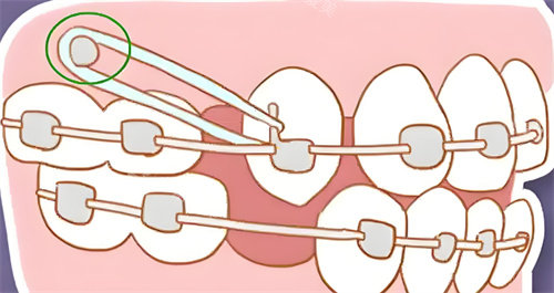 牙齿矫正卡通图片