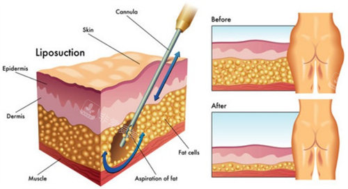妈妈臀吸脂 妈妈臀吸脂