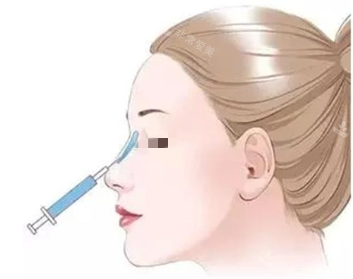 玻尿酸隆鼻示意图 玻尿酸隆鼻示意图
