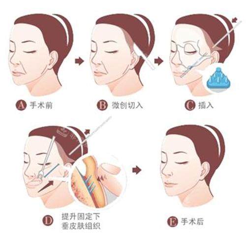 拉皮手术过程图