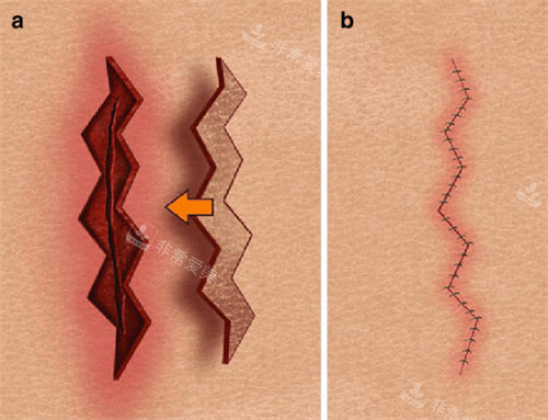 疤痕修复缝合 疤痕修复缝合