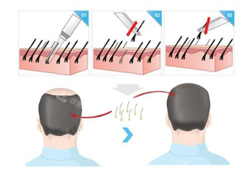 微针植发过程步骤